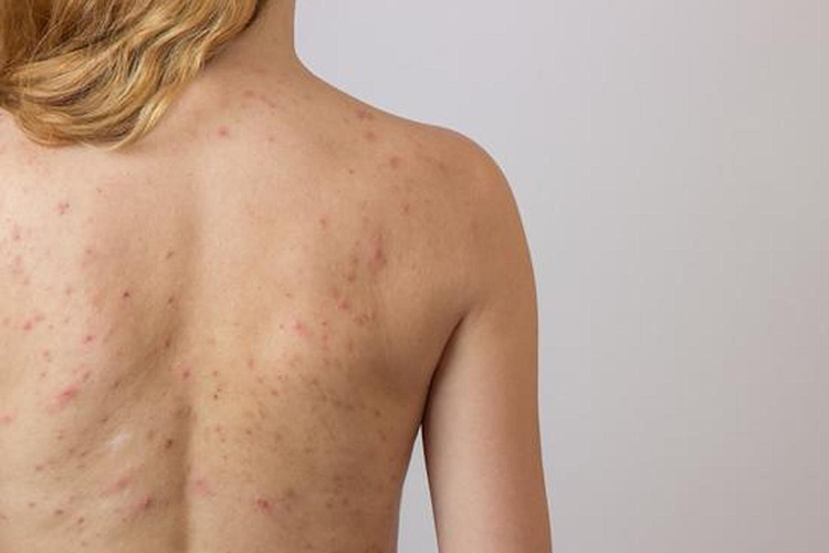 背上螨虫痘痘图 背上螨虫痘痘图