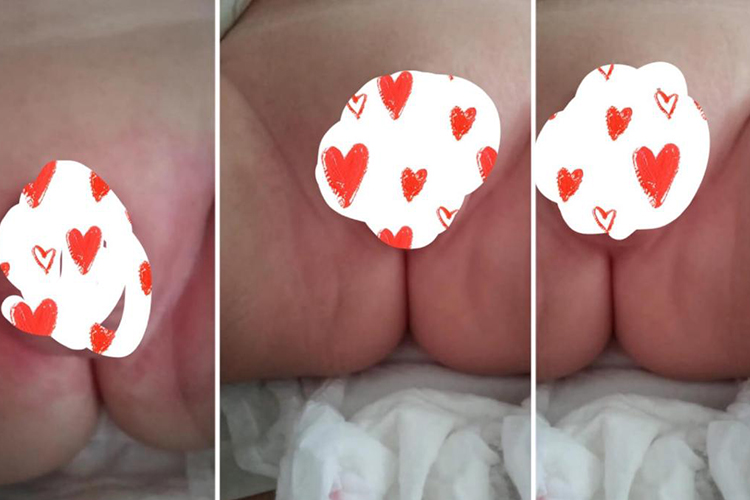 尿布皮炎红斑症状图 尿布皮炎红斑症状图