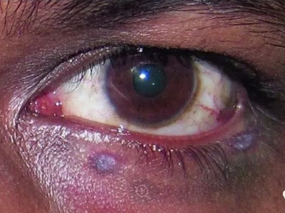 卡波西肉瘤的症状和图片 - 有来医生