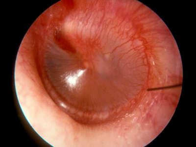 急性中耳炎耳膜鼓起来表面充血图.jpg