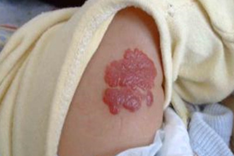小儿血管瘤大腿红色斑块图