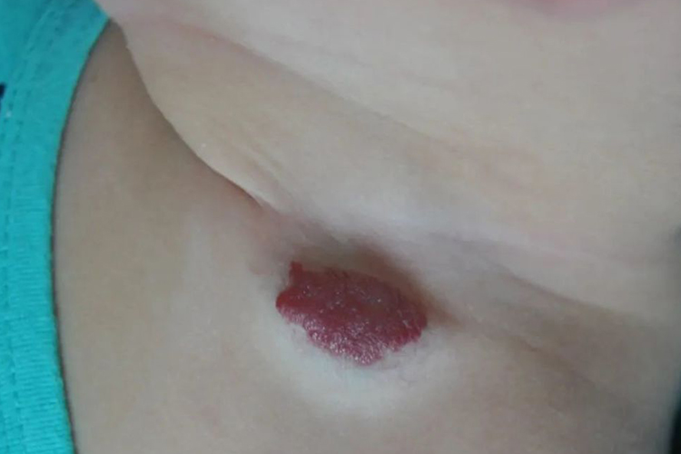 婴儿颈部单纯性血管瘤图