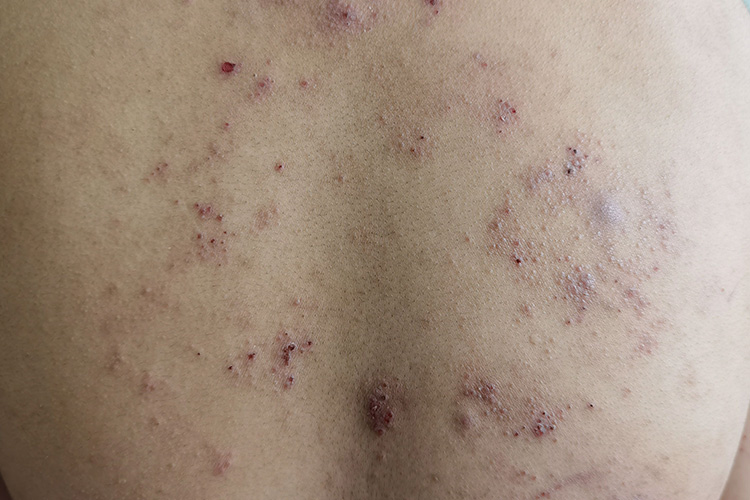 干性湿疹继发红疹、丘疹类皮损图