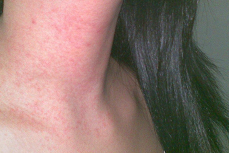 桑毛虫皮炎红点图 桑毛虫皮炎红点图