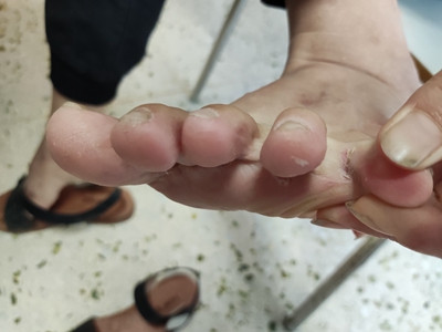 浸渍糜烂型足癣左脚脚趾缝裂口结痂图