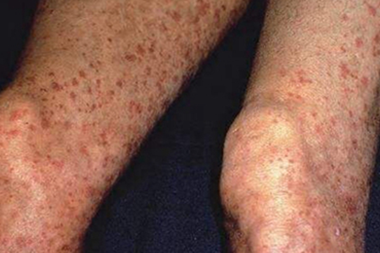 金黄色苔藓大腿症状图