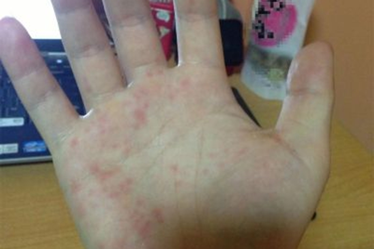 遗传性掌红斑红点图