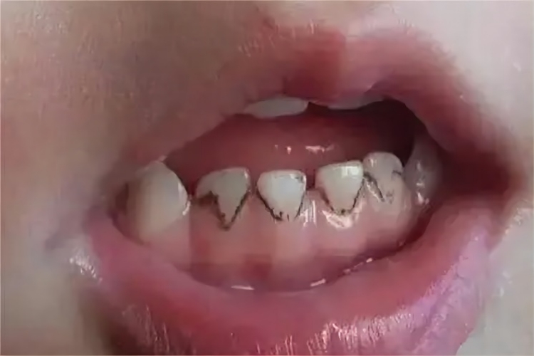 儿童黑色牙菌斑图 儿童黑色牙菌斑图