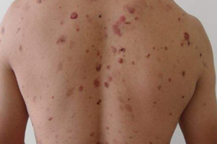 副肿瘤性天疱疮后背红斑图