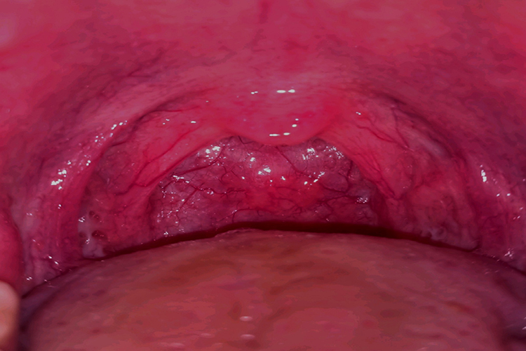 咽炎淋巴滤泡增生融合成片图