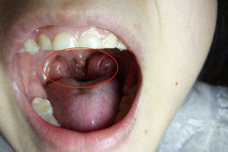 舌扁桃体肥大图