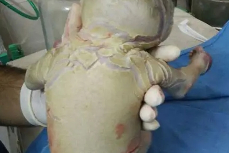 婴儿板层状鱼鳞病图 婴儿板层状鱼鳞病图