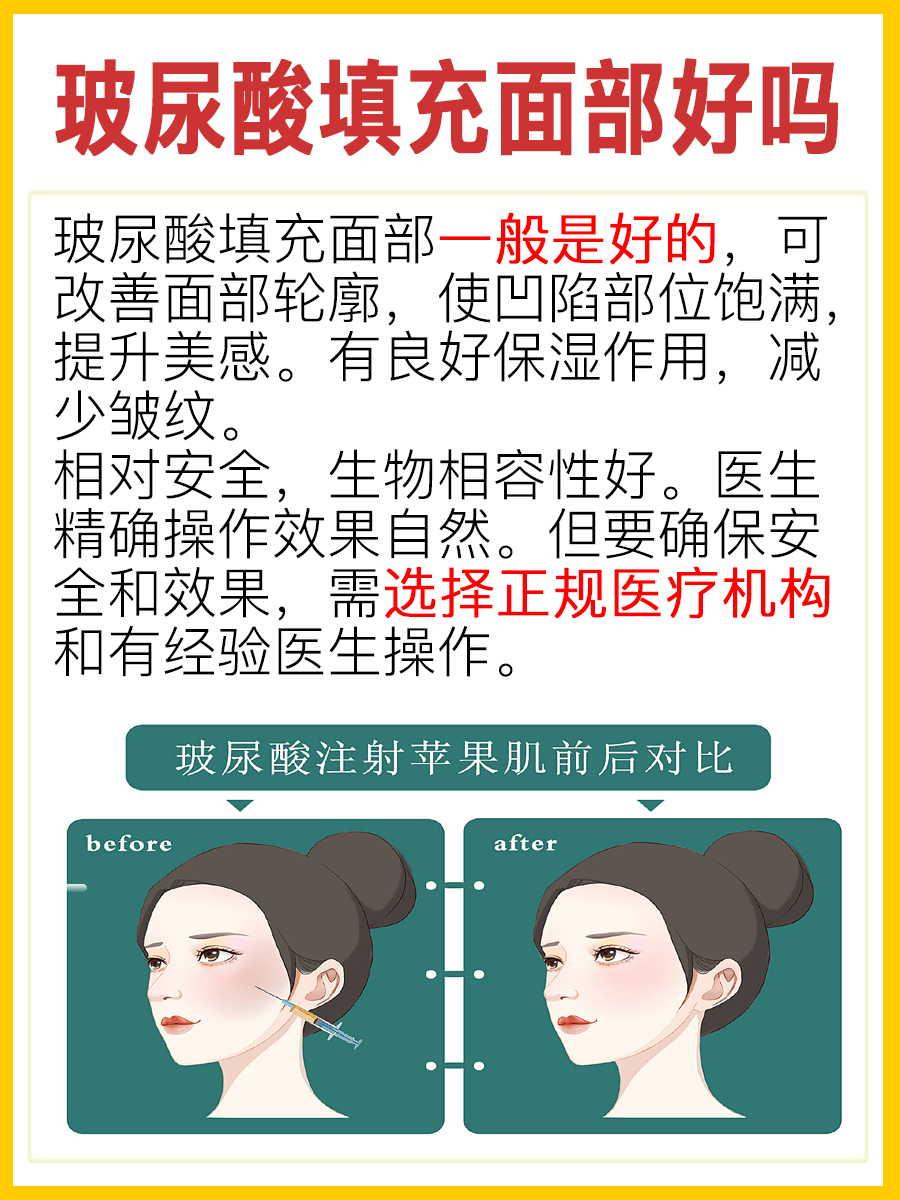 玻尿酸填充面部好吗? 一文揭晓答案