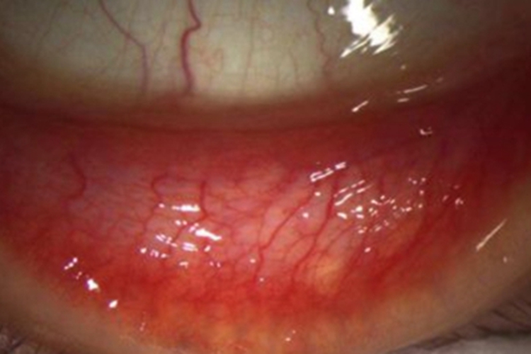 儿童过敏性结膜炎结膜血丝图 儿童过敏性结膜炎结膜血丝图