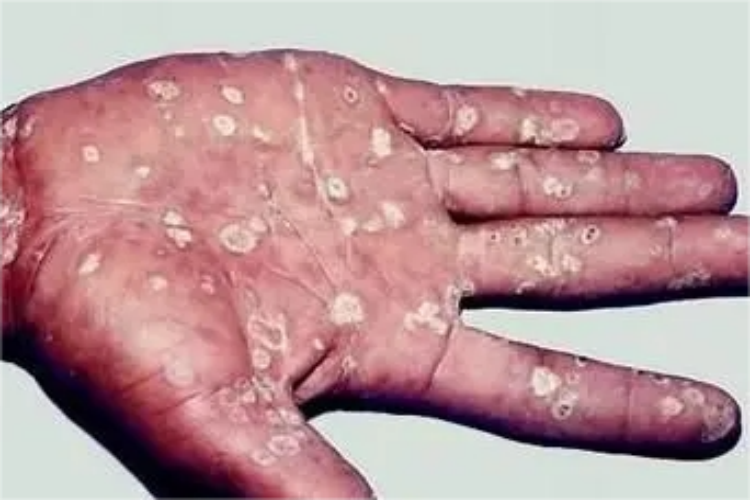 手部梅毒白斑图