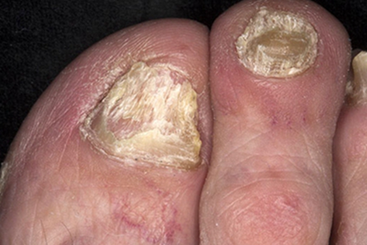 银屑病甲趾甲粗糙碎裂图