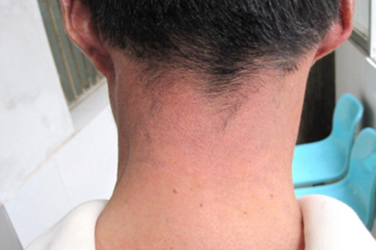 皮肤黑变病脖子后面发红图 皮肤黑变病脖子后面发红图