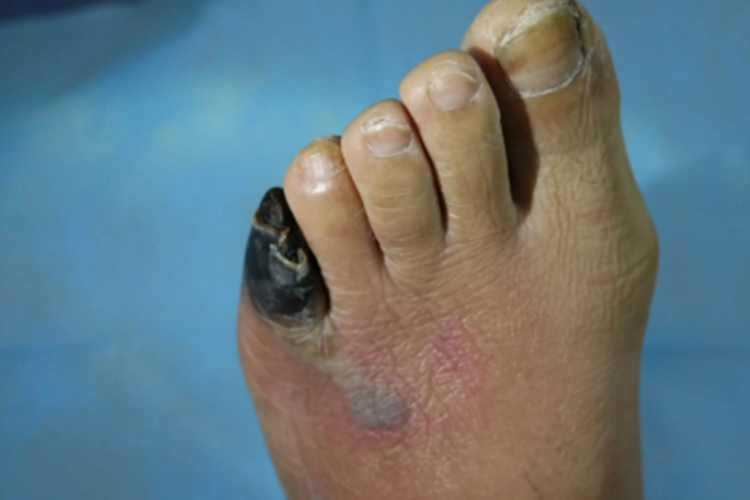 足部坏疽样改变图 足部坏疽样改变图