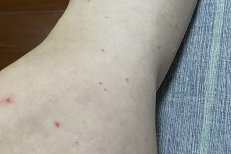 毛囊炎胳膊丘疹图