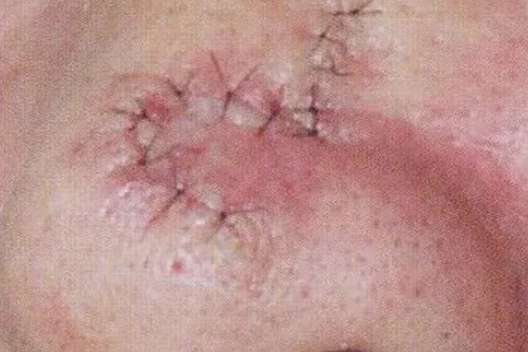 鼻子上血管瘤手术后伤口图 鼻子上血管瘤手术后伤口图