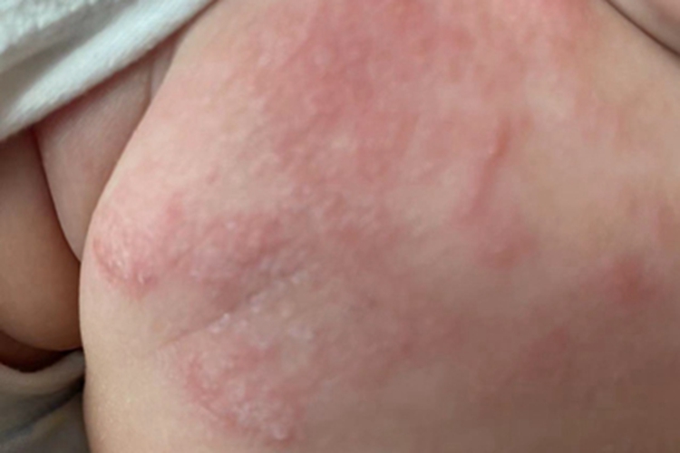 慢性湿疹胸部图