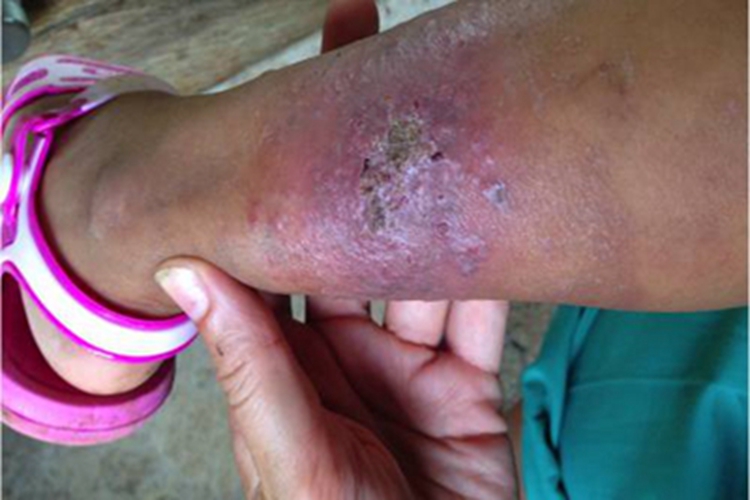 热带溃疡小腿丘疹图