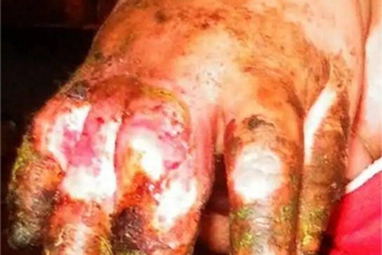 烫伤手指糜烂图