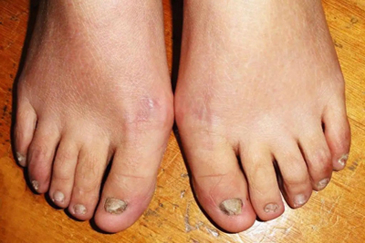 后天性厚甲症脚趾甲缩小图