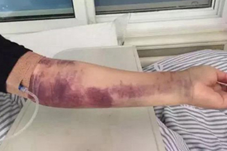 念珠状链杆菌型鼠咬热紫斑图 念珠状链杆菌型鼠咬热紫斑图