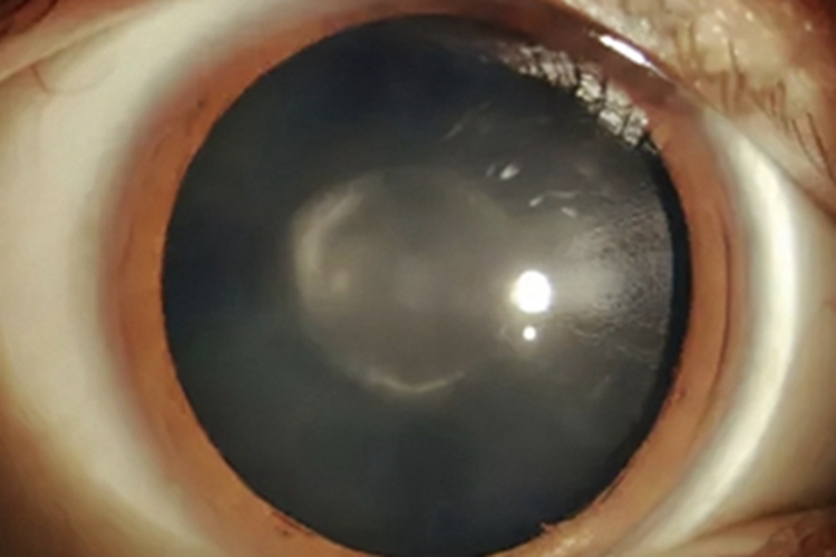 核性白内障眼部白斑图