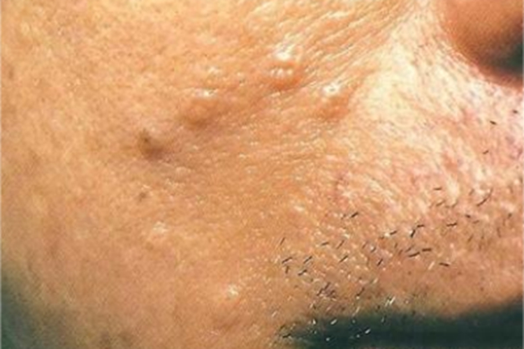 早熟性皮脂腺增生面部小坑图