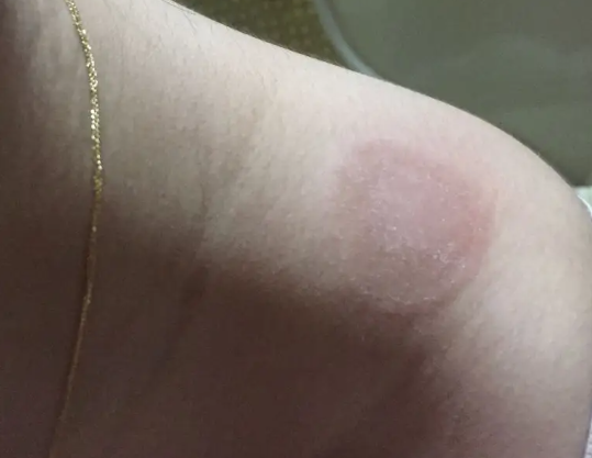 肩膀有体癣红色圆斑图