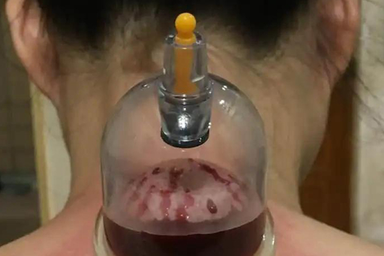 富贵包刺络拔罐图 富贵包刺络拔罐图