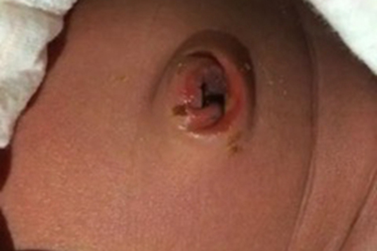 脐窝湿疹肚脐皮肤发红图