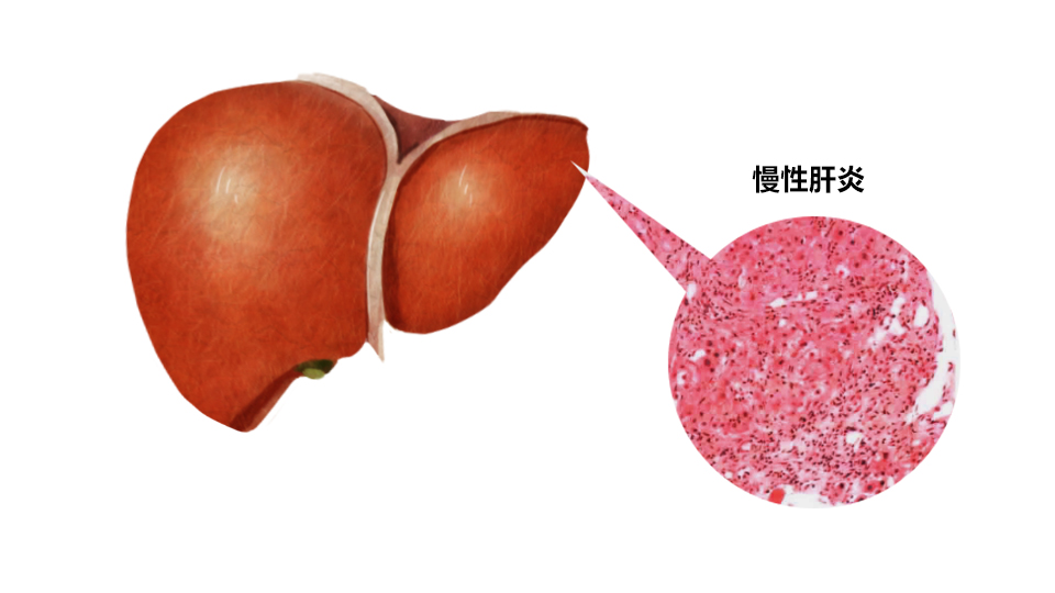 慢性肝炎图 慢性肝炎图