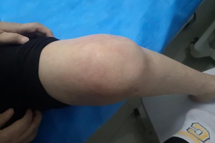 左侧髌骨骨质增生肿胀图