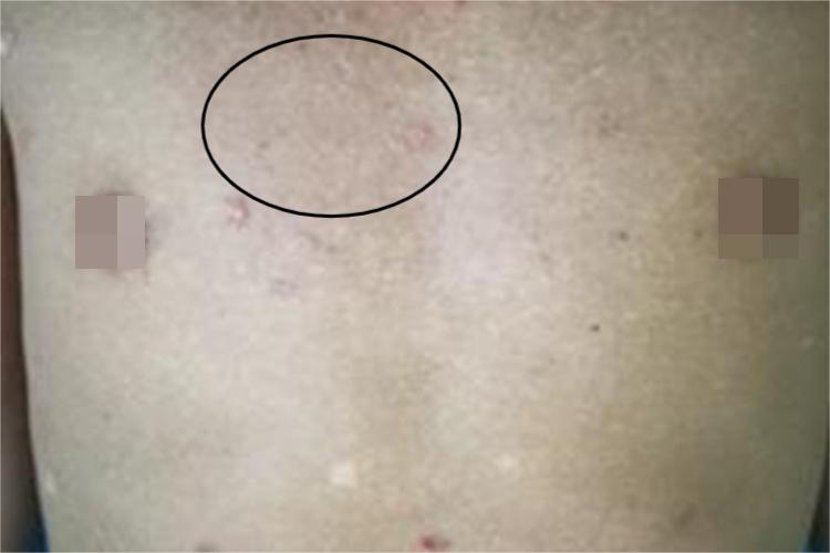 砷角化病胸部斑图