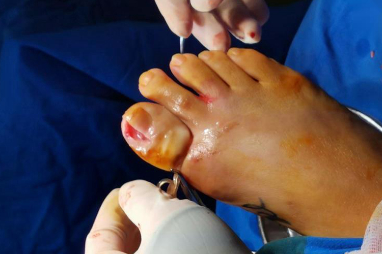 甲沟炎手术部分指甲切除图