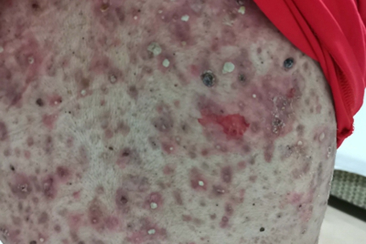 聚合性痤疮背部大红疙瘩图