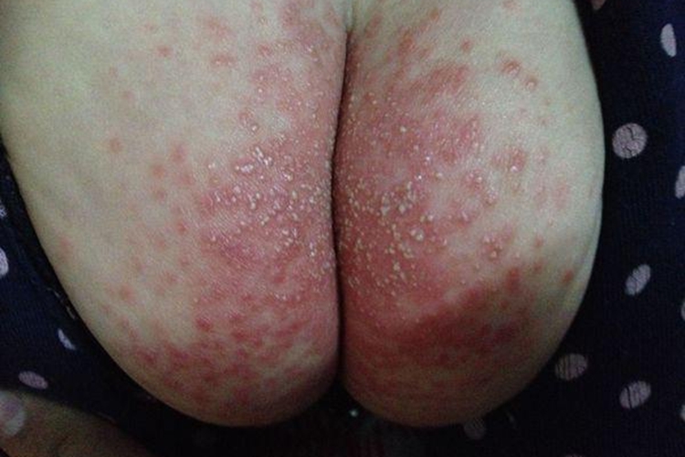 新生儿尿布皮炎脓疱图 新生儿尿布皮炎脓疱图