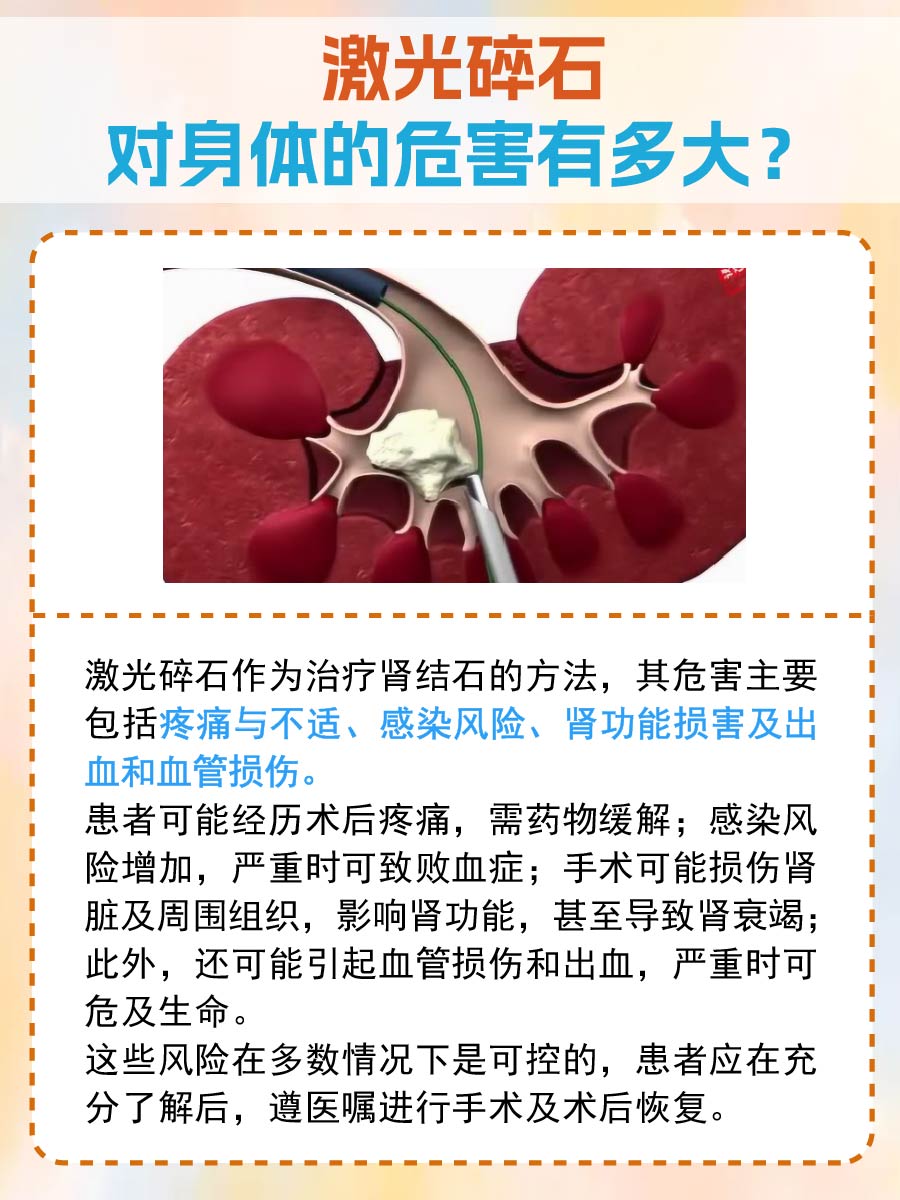 激光碎石对身体的影响,危害有多大?