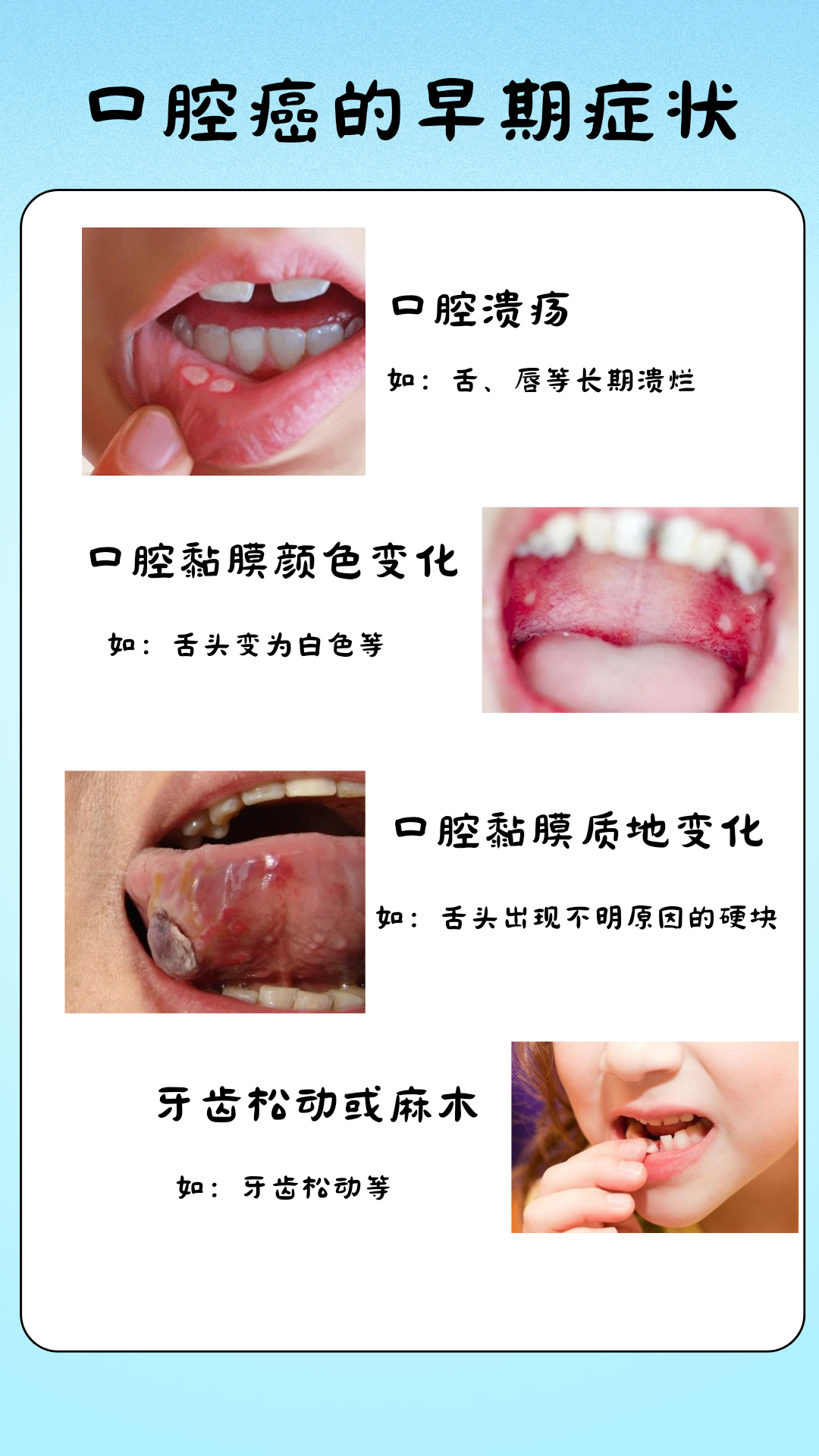 口腔癌的治愈率和存活率高吗？带你了解真实数据