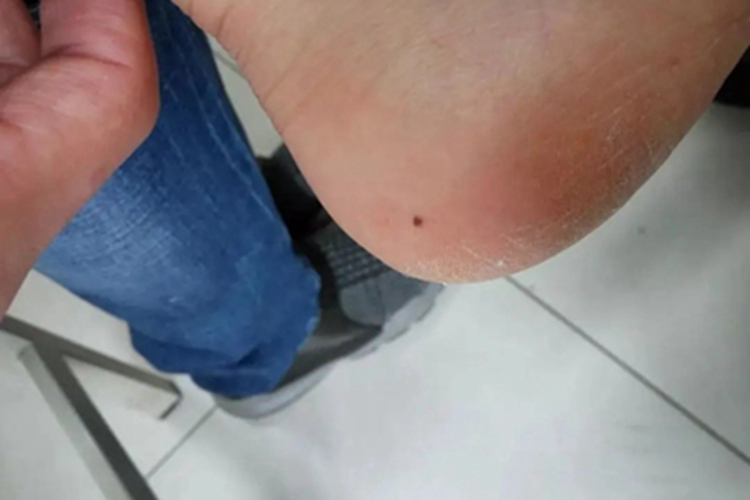 交界痣脚后跟症状图