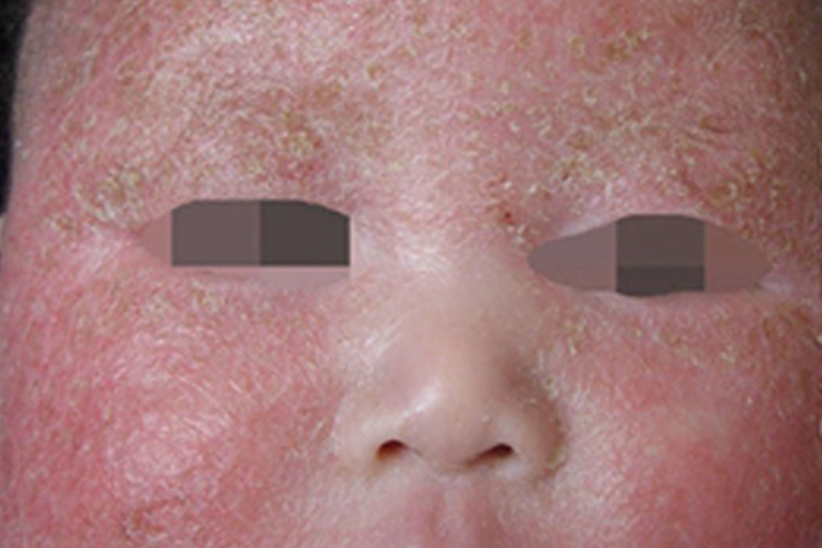 儿童期特应性皮炎面部症状图 儿童期特应性皮炎面部症状图