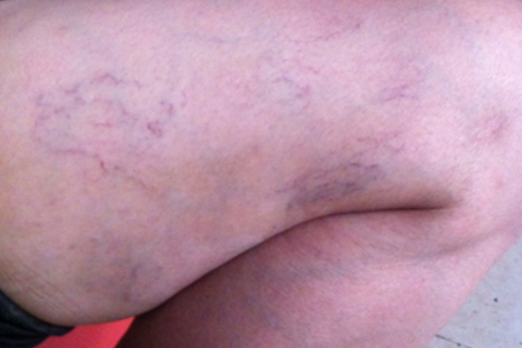 大腿内侧下肢静脉曲张图