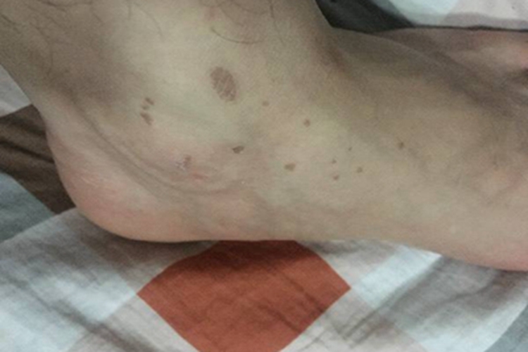 毛细血管扩张性环状紫癜脚踝斑图