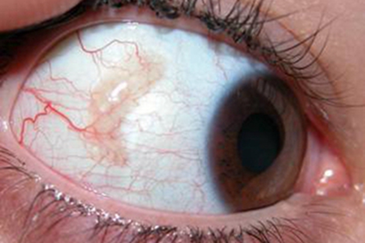 睑裂斑眼球疙瘩图 睑裂斑眼球疙瘩图