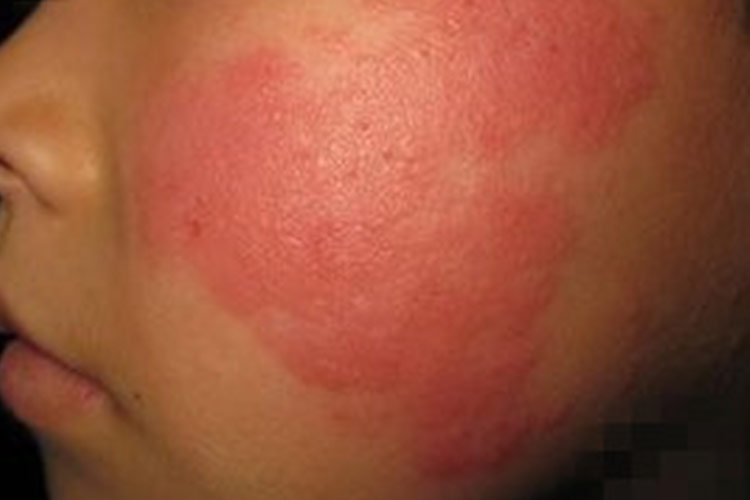接触性皮炎面部皮疹图