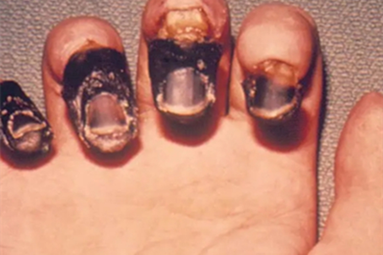 鼠疫手指尖皮肤发黑图