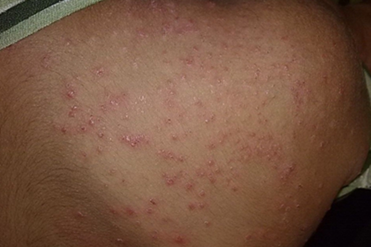 皮肤蝇蛆病症状图